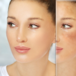 Beyond the Redness: Modern Strategies for Managing Rosacea and Demodicosis