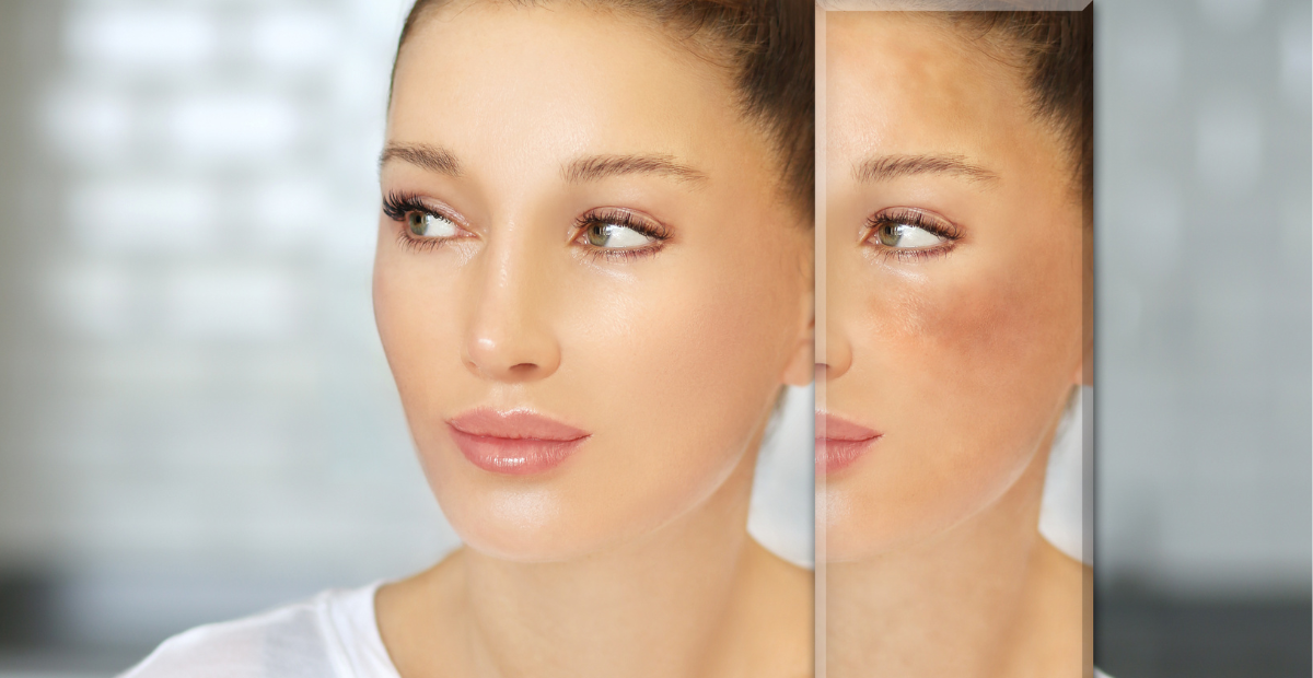 Beyond the Redness: Modern Strategies for Managing Rosacea and Demodicosis